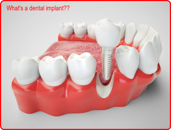 What's a dental implant image 2