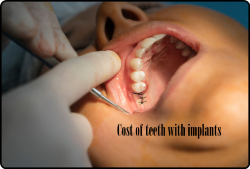 Cost of teeth with implants