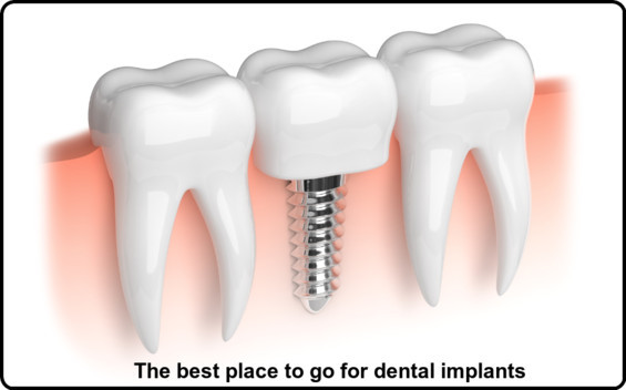 The best place to go for dental implants image