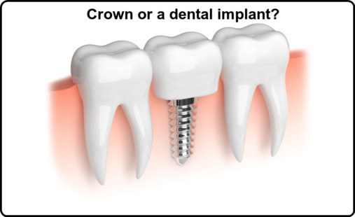 Crown or a dental implant image1