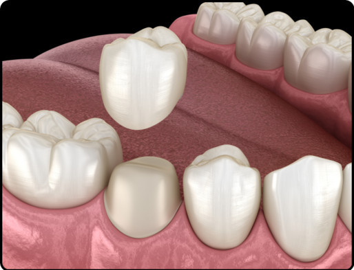 Crowns or a dental implant image 2