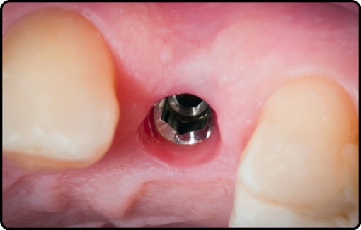 Dental implants image