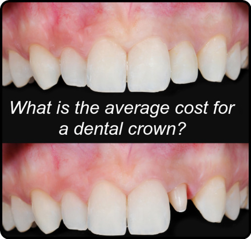 What is the average cost for a dental crown
