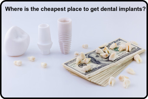 where-is-the-cheapest-place-to-get-dental-implants