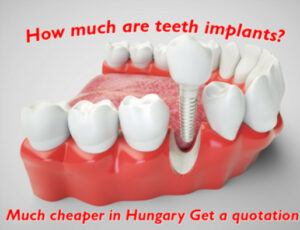 How much are teeth implants image