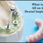 What is All on 4 dental implants image