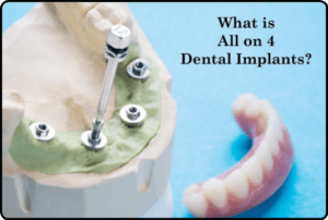 What is All on 4 dental implants image