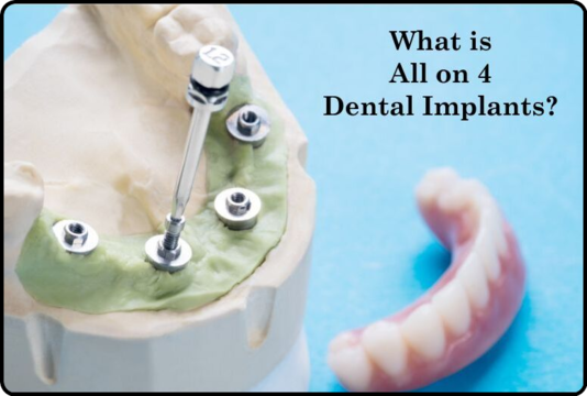 What is All on 4 dental implants