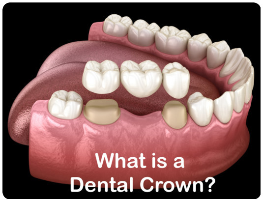 What is a dental crown