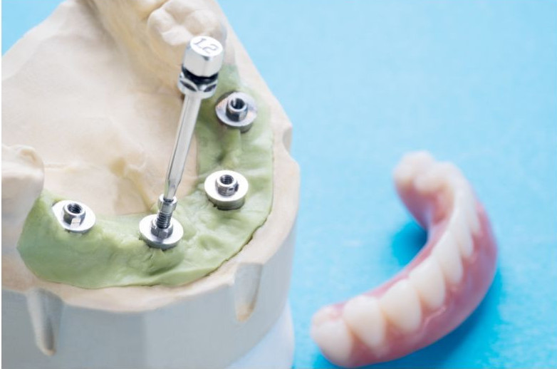 What Is All On 4 Dental Implants – Hungarian Dental Implant Centre Wexford