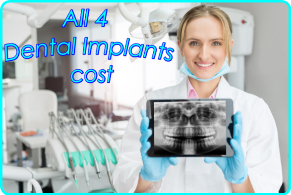 All 4 dental implants cost image