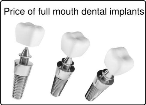 Price of full mouth dental implants