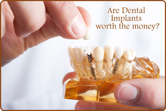 Are Dental Implants worth the money? Image