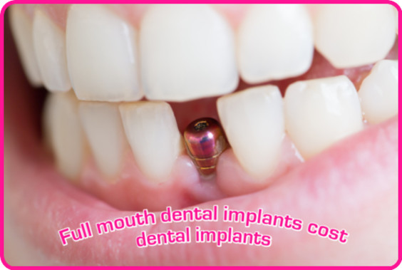 Pros and cons of dental implants
