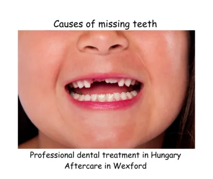 Causes of missing teeth image