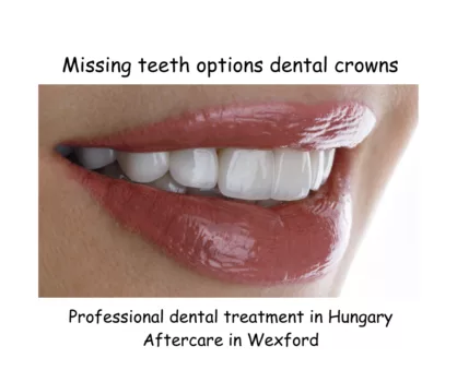 Dental crowns for missing teeth image