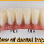 Review of dental implants