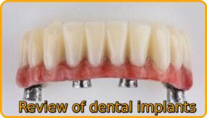 Review of dental implants