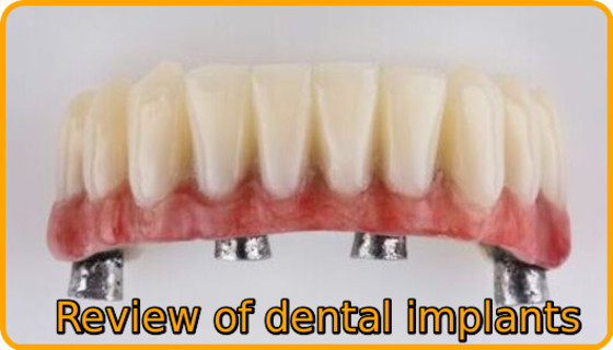 Review of dental implants 