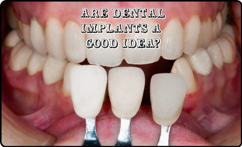 Are dental implants a good idea