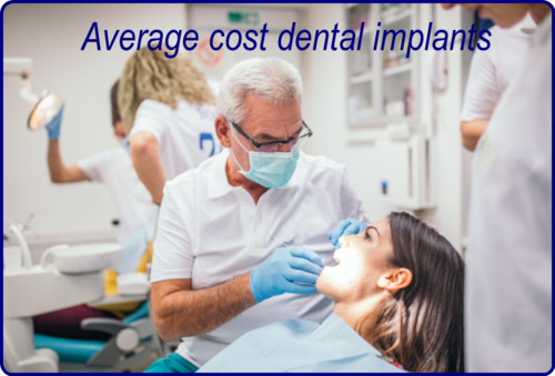 Average cost dental implants image