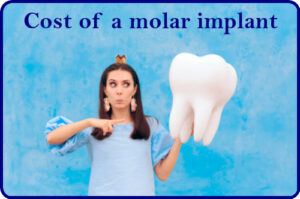 Cost of a molar implant image