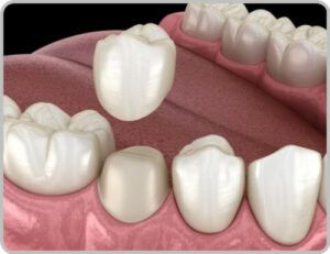 How much for dental crowns image