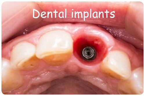Dental implants image Dental implants image