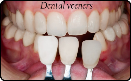 Dental veeners image