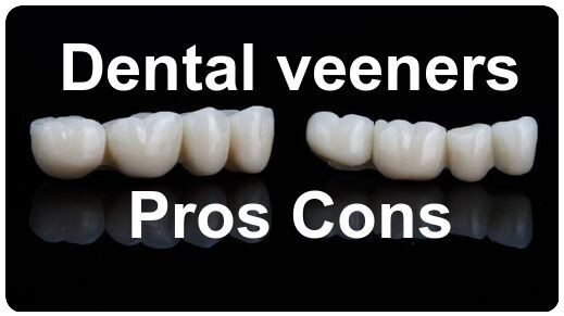 Dental veeners pros cons image