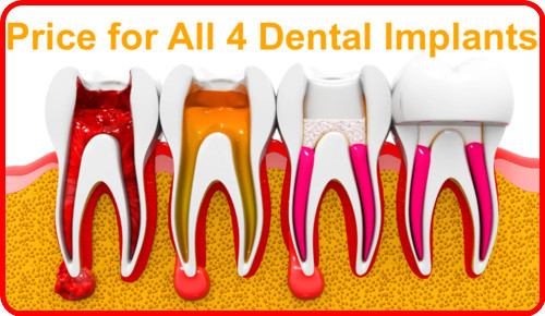 Price for All 4 dental implants image