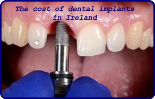 The cost of dental implants in Ireland image