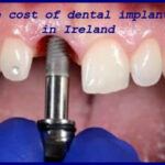 The cost of dental implants in Ireland image