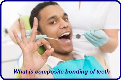 What is composite bonding of teeth image