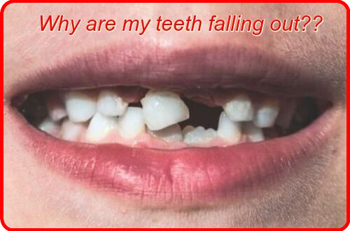 Why are my teeth falling out?? Image Why are my teeth falling out?? Image