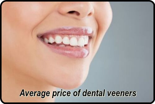 Average price of dental veneers image