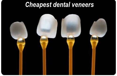 Cheapest dental veneers image