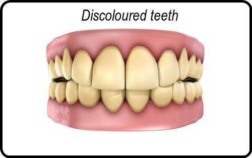 Discoloured teeth image