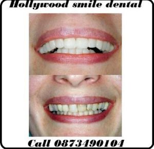 Hollywood Smile dental image