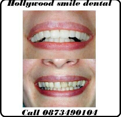 Hollywood smile dental call image