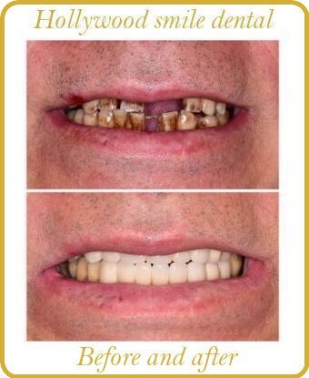 Hollywood smile dental image 2