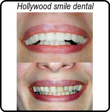 Hollywood smile dental image