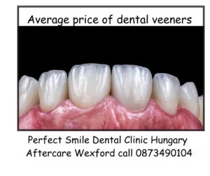 Average price of dental veeners image