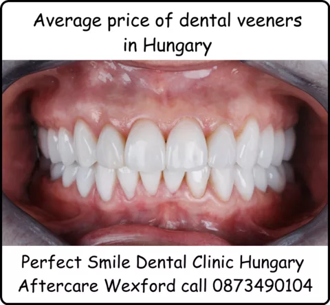 Veeners in Perfect Smile dental clinic Hungary image