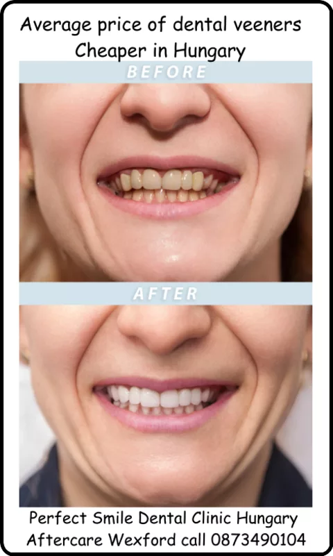 Dental veeners before and after picture 