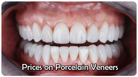 Prices on porcelain veneers image