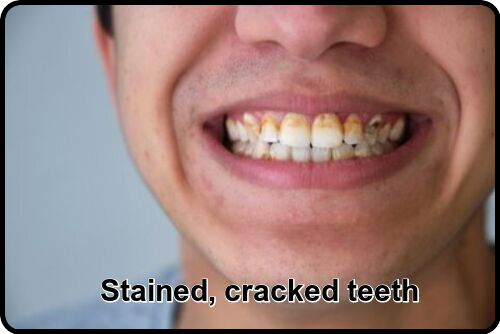 Stained cracked teeth image