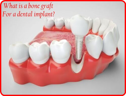 What is a bone graft for a dental implant image