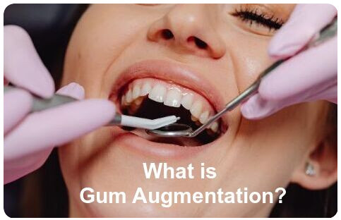 What is gum augmentation image