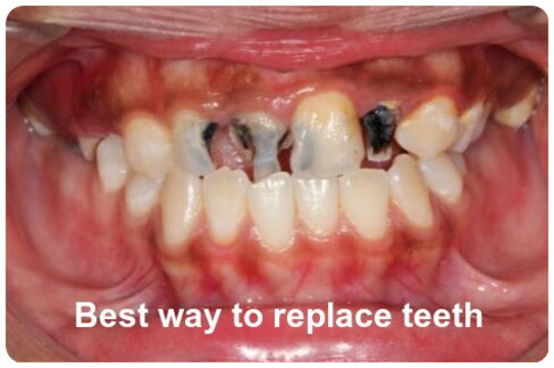 Best way to replace teeth image